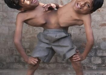 Эти братья — сиамские близнецы из Индии