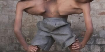 Эти братья — сиамские близнецы из Индии